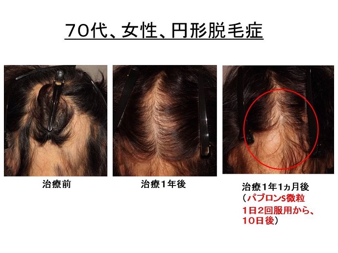 円形脱毛症　病院""